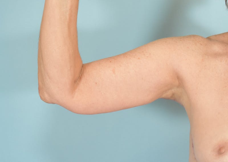 Arm Lift Before & After Gallery - Patient 308208 - Image 4