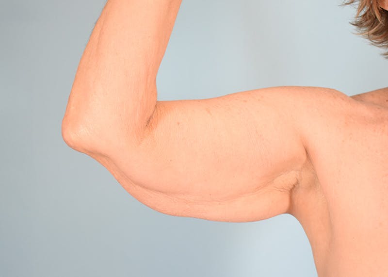 Arm Lift Before & After Gallery - Patient 308208 - Image 3