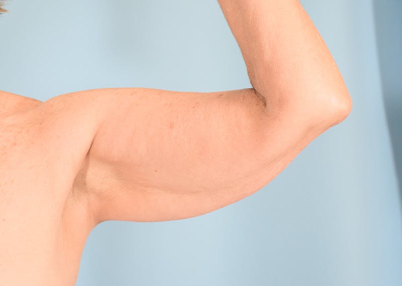 Arm Lift Before & After Gallery - Patient 308208 - Image 5