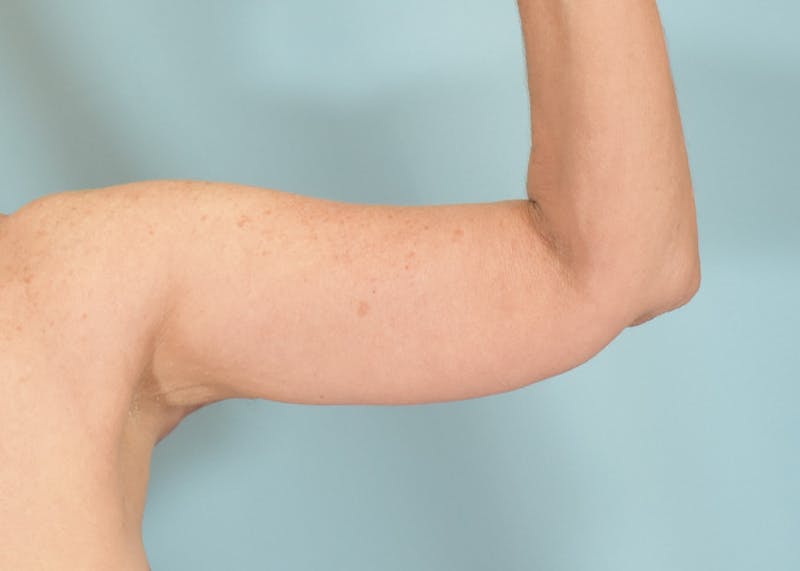 Arm Lift Before & After Gallery - Patient 308208 - Image 6