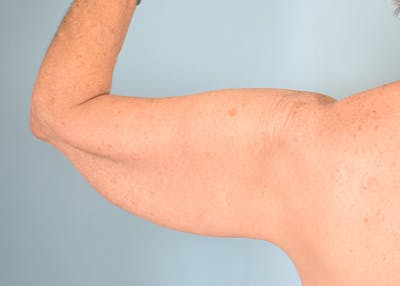 Arm Lift Before & After Gallery - Patient 308208 - Image 1