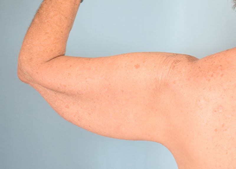 Arm Lift Before & After Gallery - Patient 308208 - Image 1