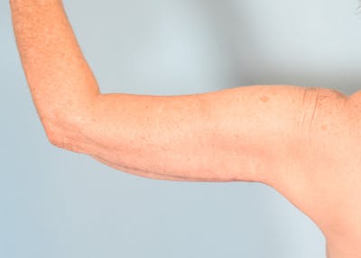 Arm Lift Before & After Gallery - Patient 308208 - Image 2