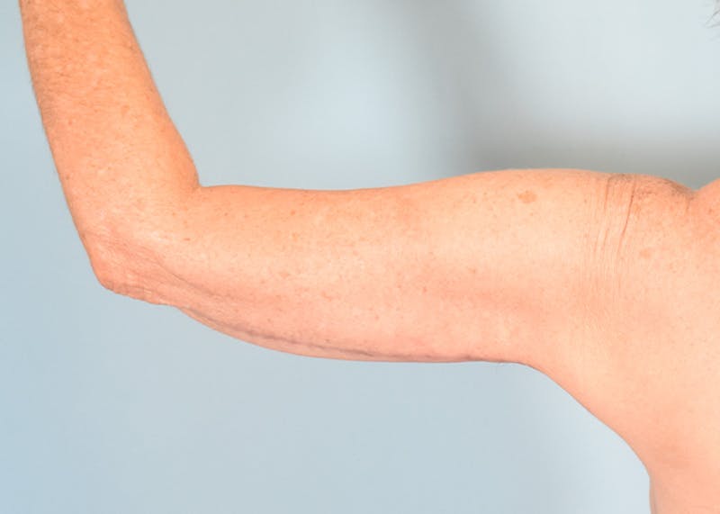 Arm Lift Before & After Gallery - Patient 308208 - Image 2