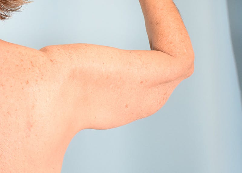 Arm Lift Before & After Gallery - Patient 308208 - Image 7