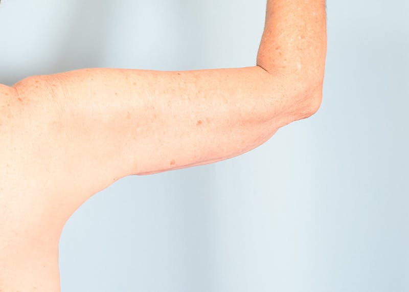 Arm Lift Before & After Gallery - Patient 308208 - Image 8