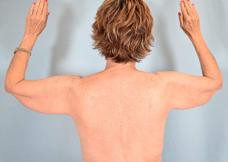 Arm Lift Before & After Gallery - Patient 308208 - Image 9