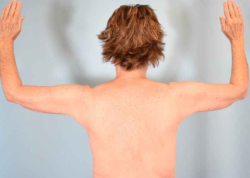 Arm Lift Before & After Gallery - Patient 308208 - Image 10