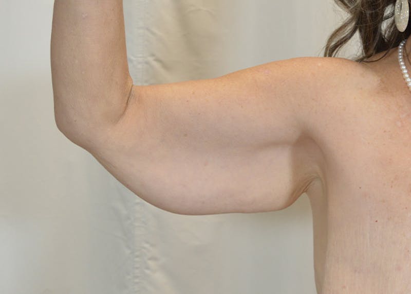 Arm Lift Before & After Gallery - Patient 200547 - Image 7