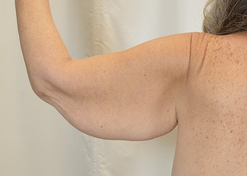 Arm Lift Before & After Gallery - Patient 200547 - Image 5