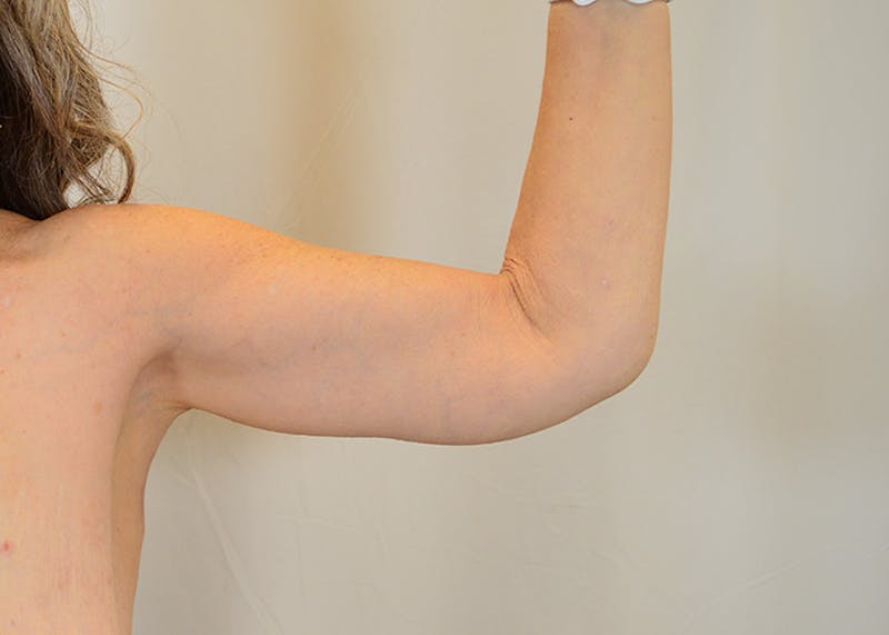 Arm Lift Before & After Gallery - Patient 200547 - Image 2