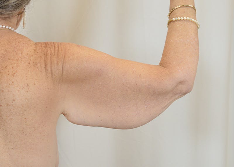 Arm Lift Before & After Gallery - Patient 200547 - Image 3