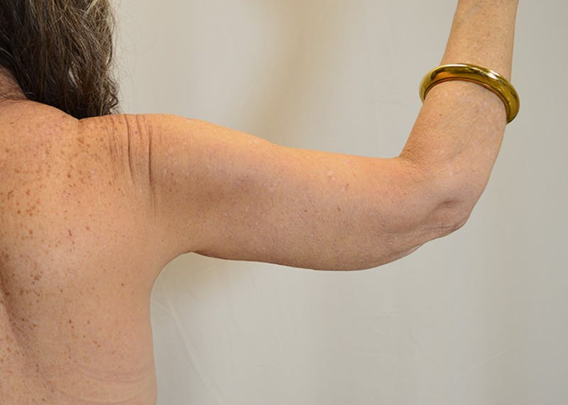 Arm Lift Before & After Gallery - Patient 200547 - Image 4