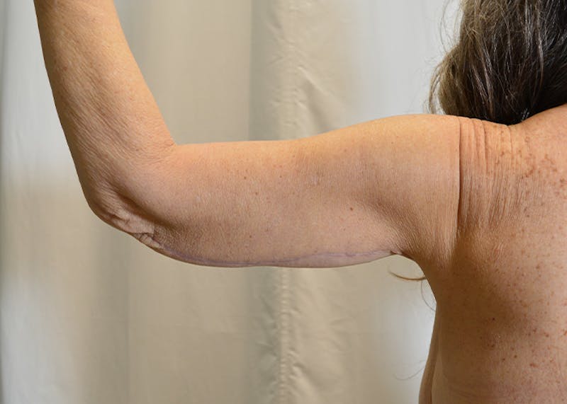 Arm Lift Before & After Gallery - Patient 200547 - Image 6