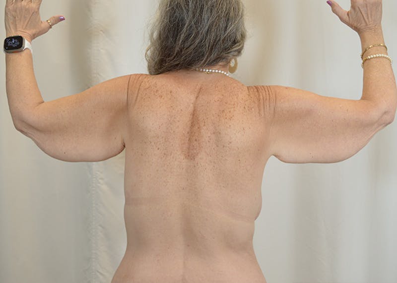Arm Lift Before & After Gallery - Patient 200547 - Image 9