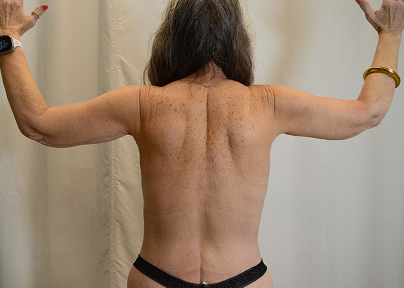 Arm Lift Before & After Gallery - Patient 200547 - Image 10