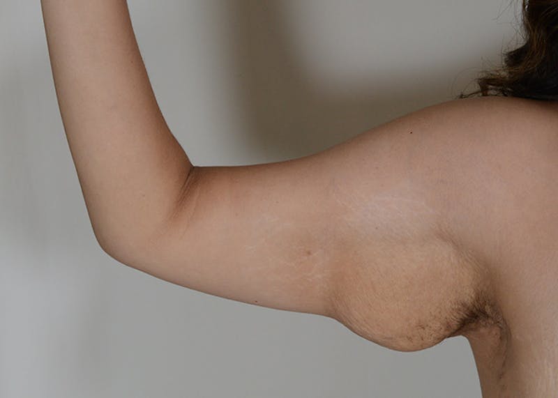 Arm Lift Before & After Gallery - Patient 117529 - Image 5