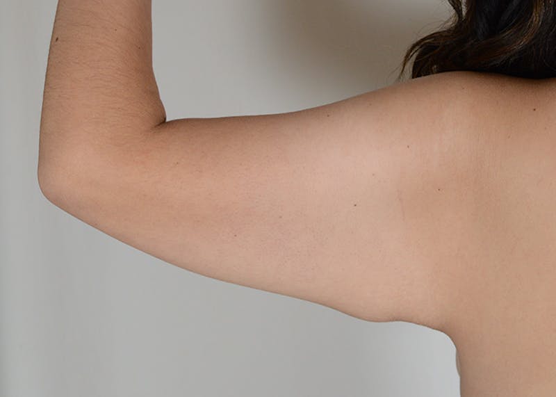 Arm Lift Before & After Gallery - Patient 117529 - Image 7