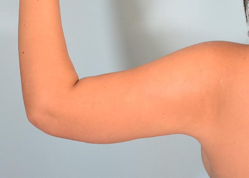 Arm Lift Before & After Gallery - Patient 117529 - Image 8