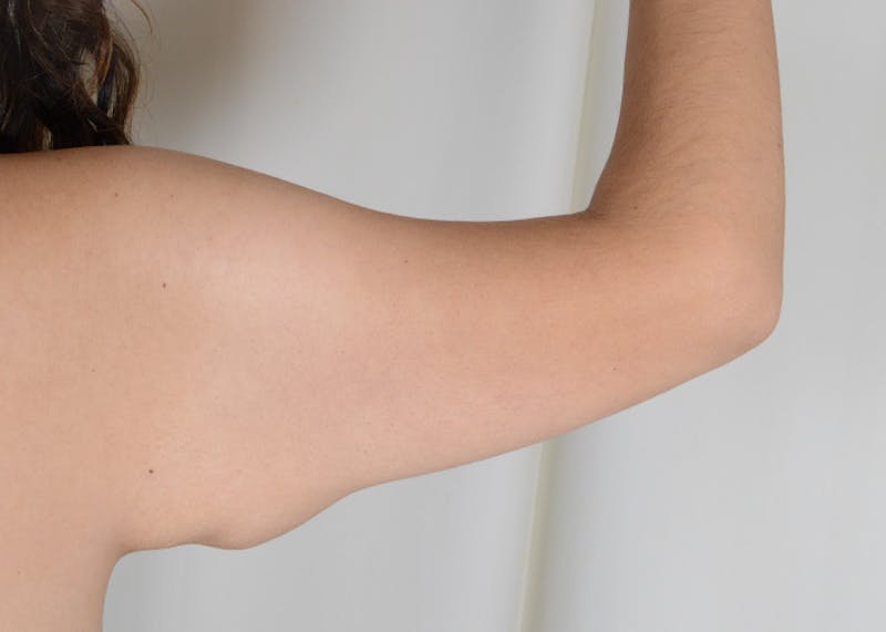 Arm Lift Before & After Gallery - Patient 117529 - Image 3