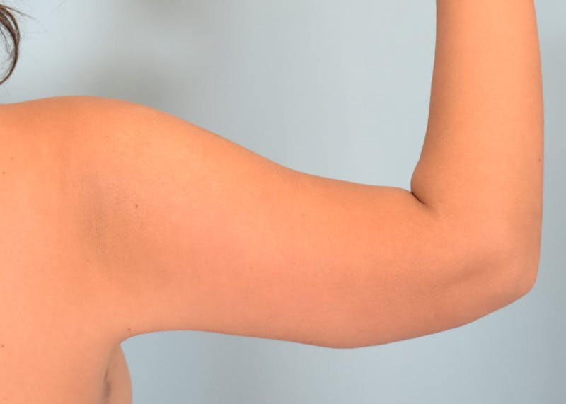 Arm Lift Before & After Gallery - Patient 117529 - Image 4