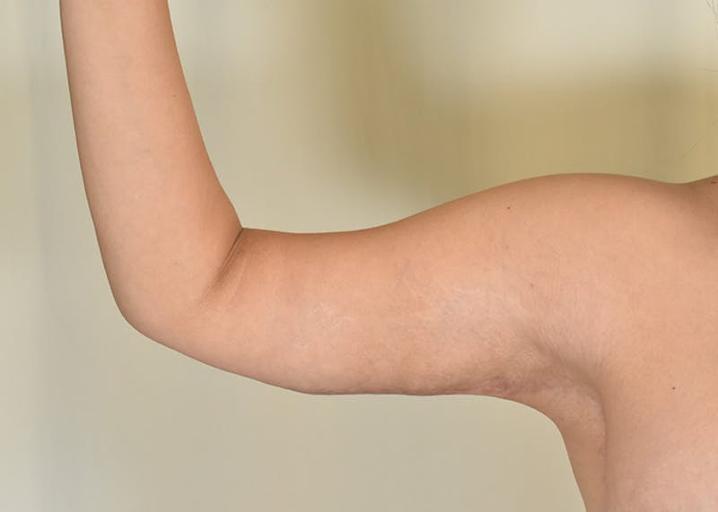 Arm Lift Before & After Gallery - Patient 117529 - Image 6