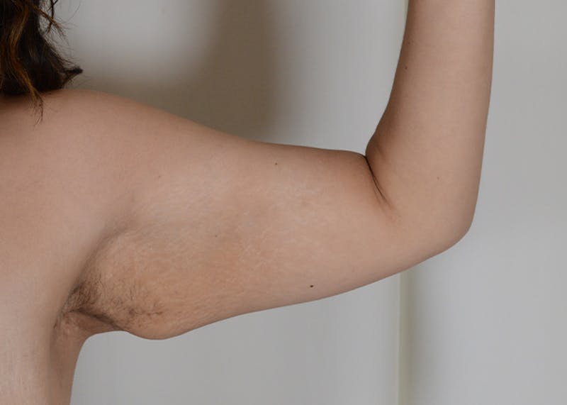 Arm Lift Before & After Gallery - Patient 117529 - Image 1