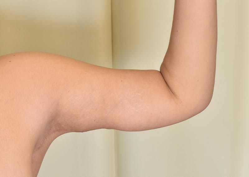 Arm Lift Before & After Gallery - Patient 117529 - Image 2