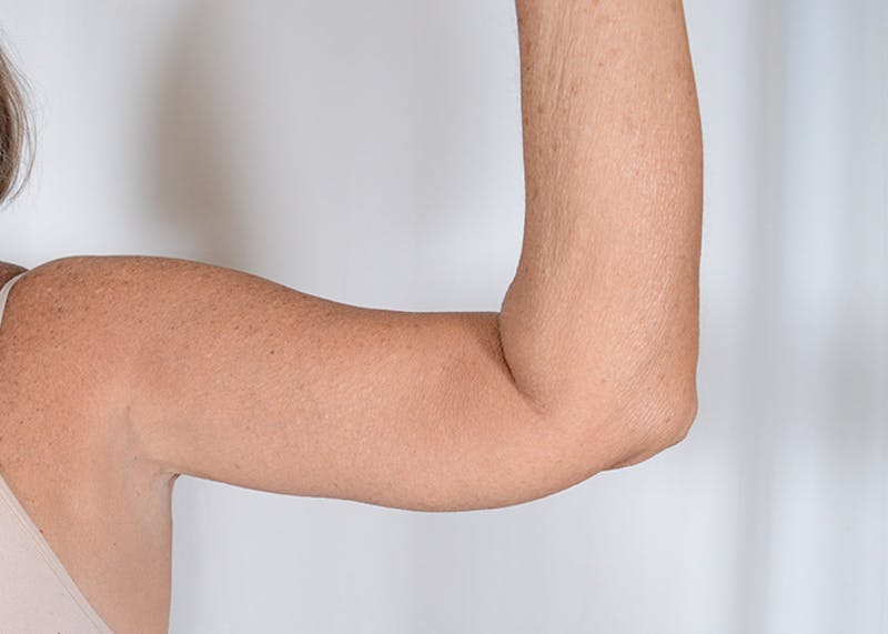 Arm Lift Before & After Gallery - Patient 395329 - Image 6