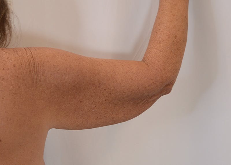 Arm Lift Before & After Gallery - Patient 395329 - Image 3