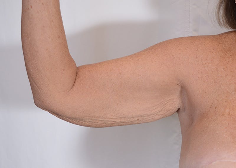 Arm Lift Before & After Gallery - Patient 395329 - Image 7
