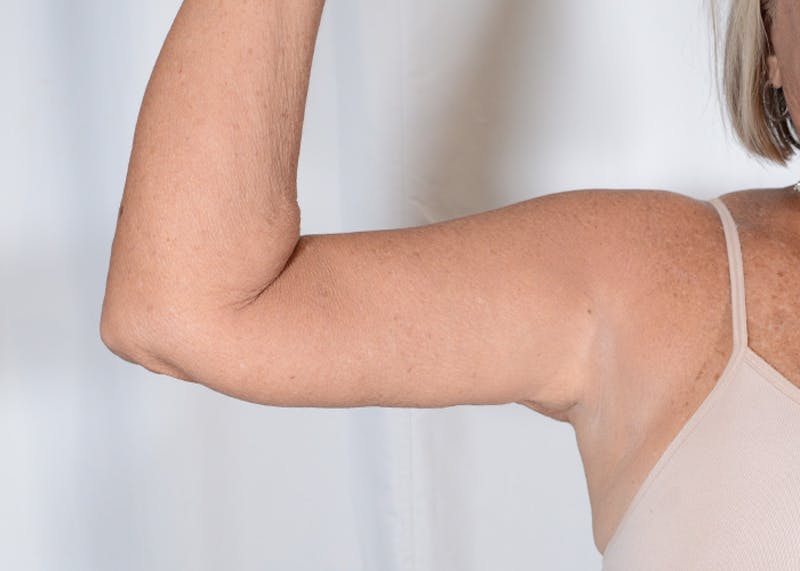 Arm Lift Before & After Gallery - Patient 395329 - Image 8