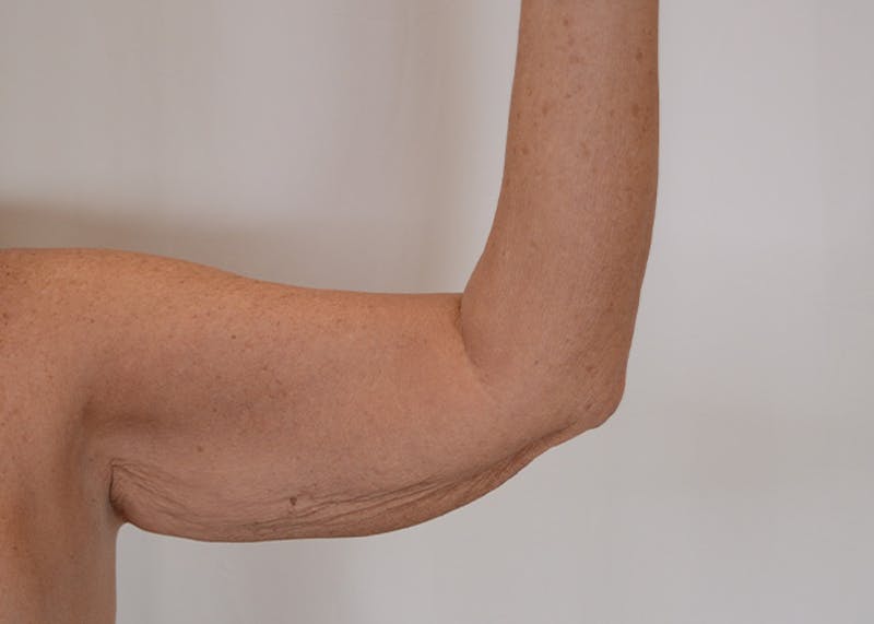 Arm Lift Before & After Gallery - Patient 395329 - Image 5
