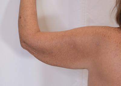 Arm Lift Before & After Gallery - Patient 395329 - Image 1