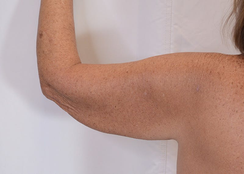 Arm Lift Before & After Gallery - Patient 395329 - Image 1