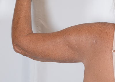 Arm Lift Before & After Gallery - Patient 395329 - Image 2