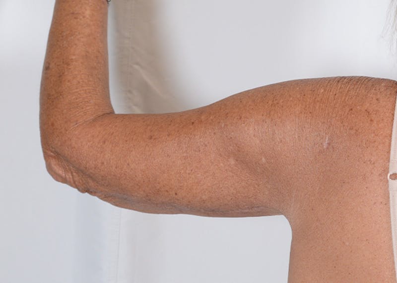Arm Lift Before & After Gallery - Patient 395329 - Image 2