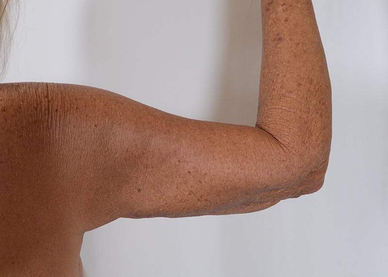 Arm Lift Before & After Gallery - Patient 395329 - Image 4
