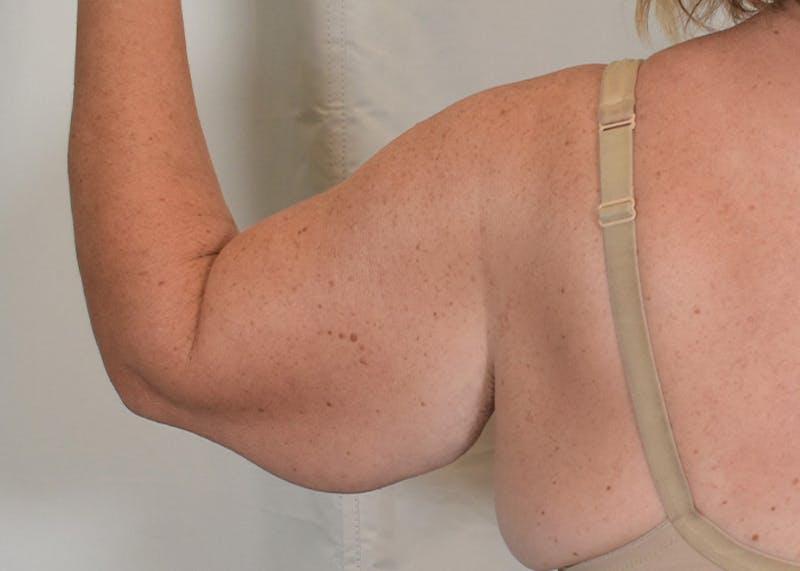 Arm Lift Before & After Gallery - Patient 938043 - Image 3