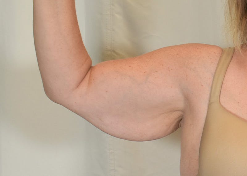 Arm Lift Before & After Gallery - Patient 938043 - Image 5
