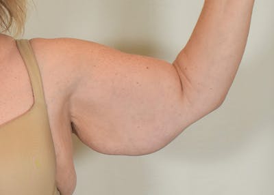 Arm Lift Before & After Gallery - Patient 938043 - Image 1