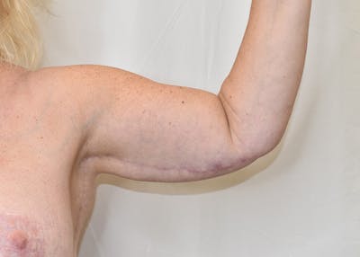 Arm Lift Before & After Gallery - Patient 938043 - Image 2