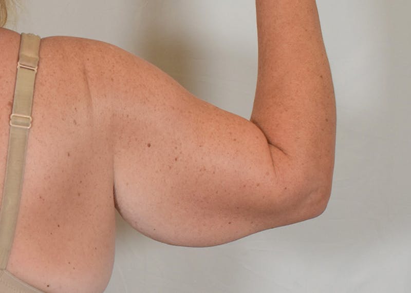 Arm Lift Before & After Gallery - Patient 938043 - Image 7