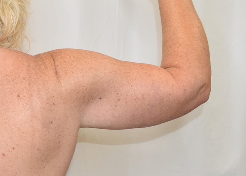 Arm Lift Before & After Gallery - Patient 938043 - Image 8