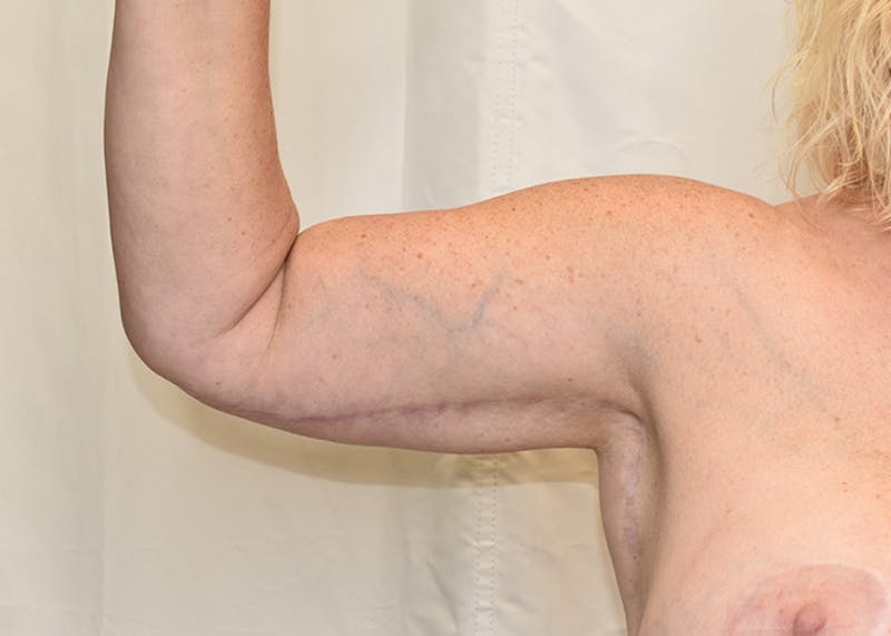 Arm Lift Before & After Gallery - Patient 938043 - Image 6