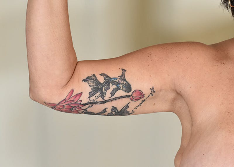 Arm Lift Before & After Gallery - Patient 384286 - Image 6