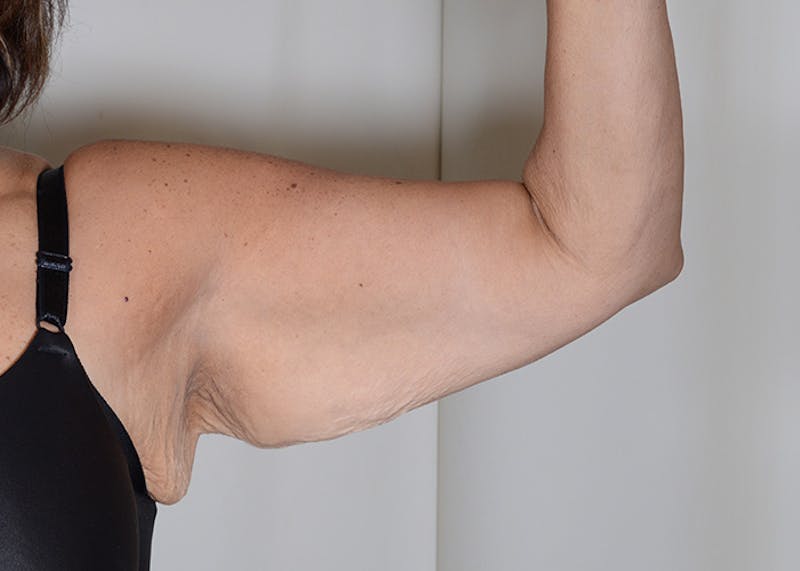 Arm Lift Before & After Gallery - Patient 384286 - Image 3