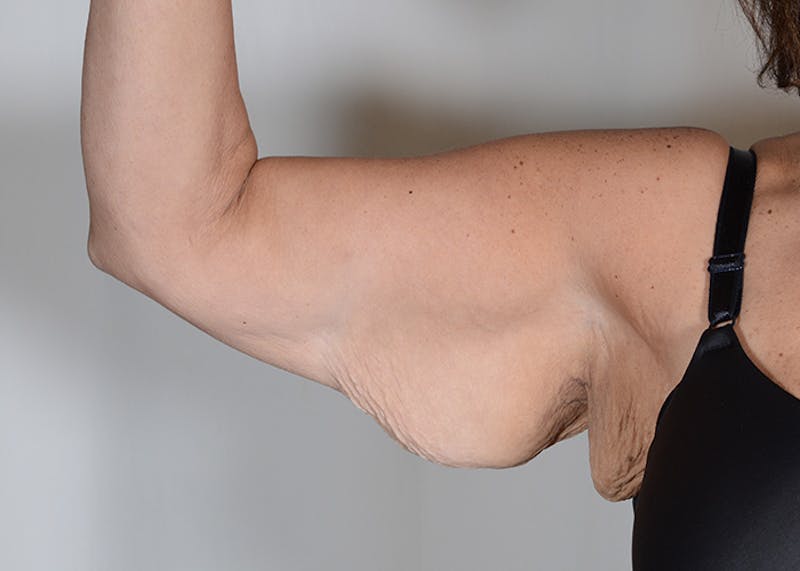 Arm Lift Before & After Gallery - Patient 384286 - Image 5