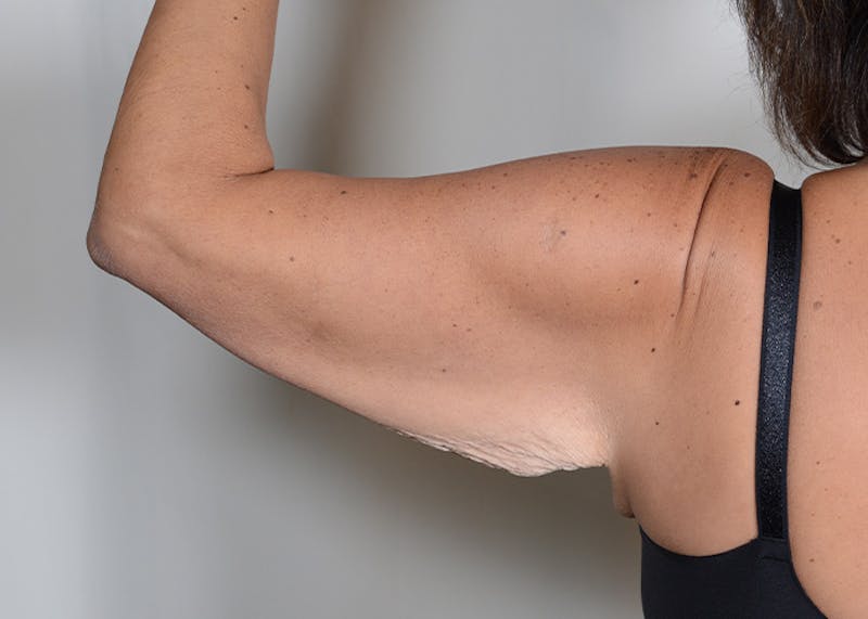 Arm Lift Before & After Gallery - Patient 384286 - Image 7
