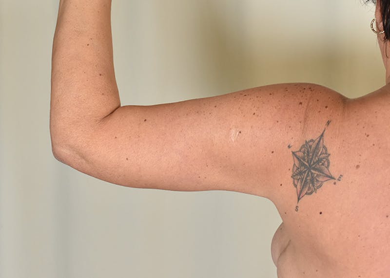 Arm Lift Before & After Gallery - Patient 384286 - Image 8